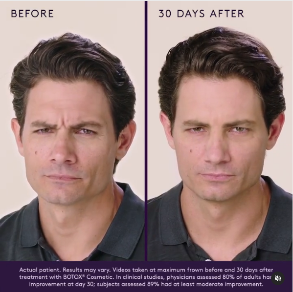 Botox Before and After photo for Botox Myths Debunked by Dr. Green at MGMD Aesthetics