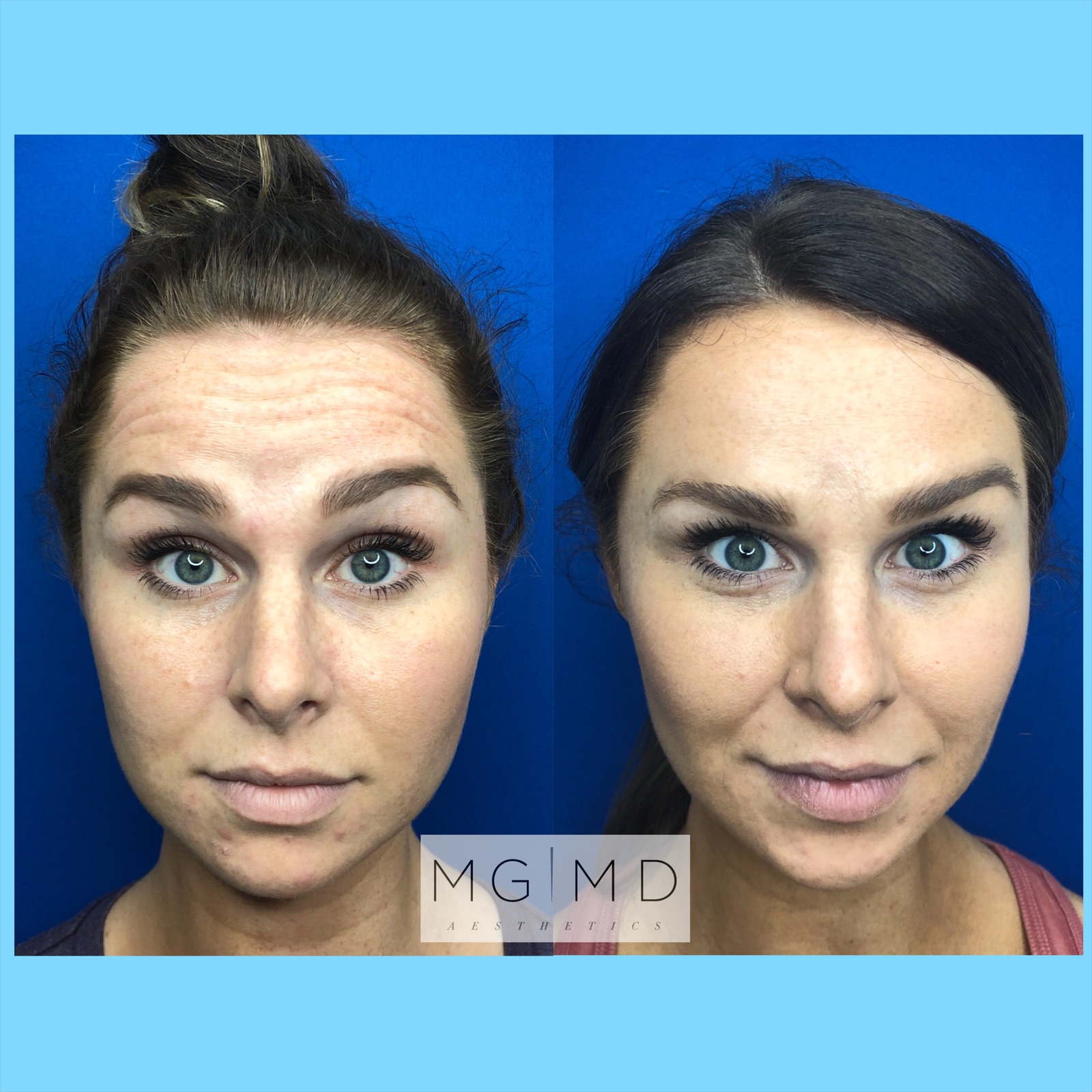 Forehead Botox Before and After - MGMD Aesthetics